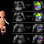 Ecocardiograma Fetal: O que é e quando fazer?