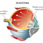 Glaucoma durante a gestação, o que fazer?