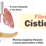 Fibrose Cística tem cura? Veja sintomas, diagnóstico e tratamento