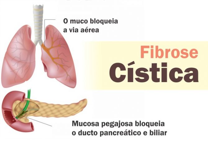 Fibrose Cística Tem Cura Veja Sintomas Diagnóstico E Tratamento