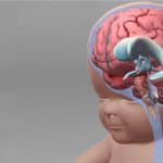 Hidrocefalia em Bebê: sintomas, causas, tratamento