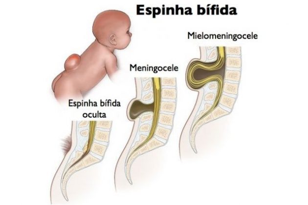 Espinha Bífida Oculta E Cística Causas Sintomas Tratamento 5814