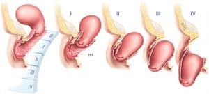 Prolapso Uterino Sintomas Causas Graus E Tratamento